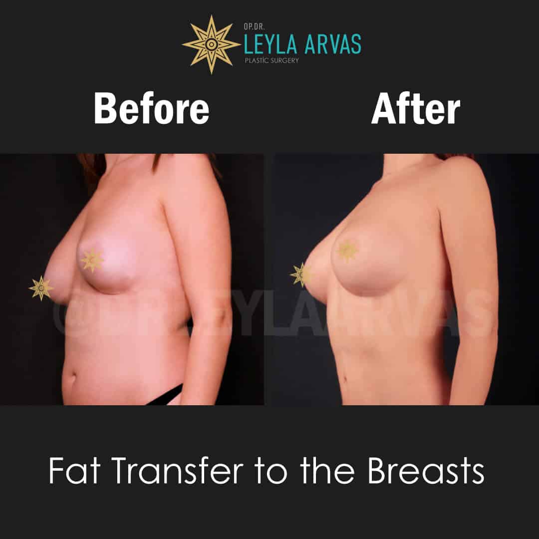 Fat Transfer Breast Enlargement - Price - Istanbul, Turkey - Op. Dr. Leyla  Arvas