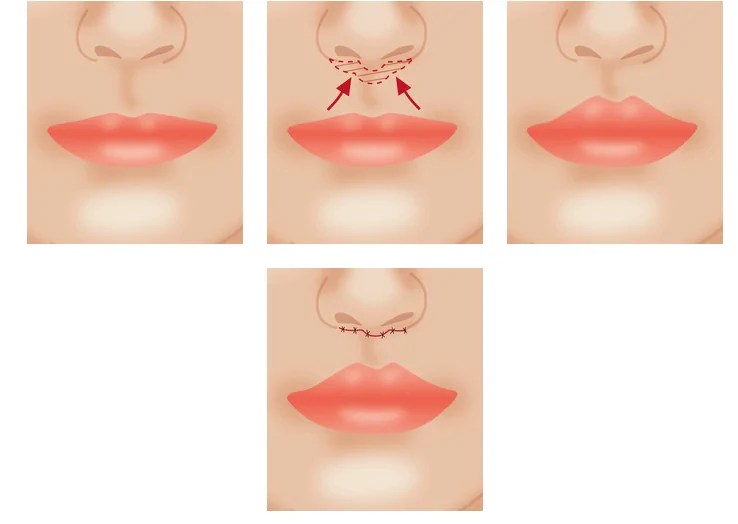 lip lift