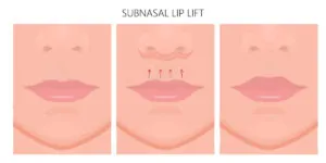 Subnazal Lip lift