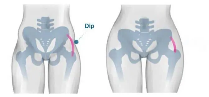 hip dips