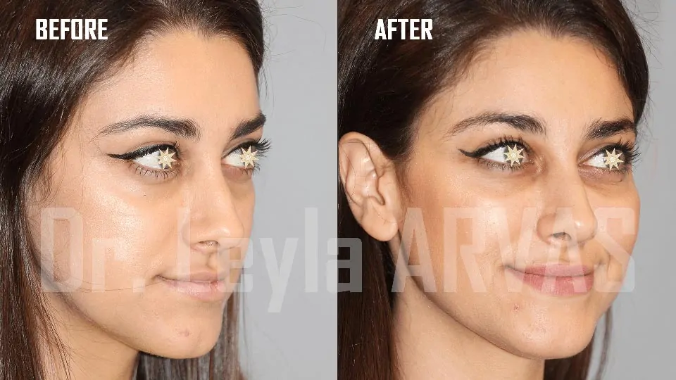 Dermal fillers