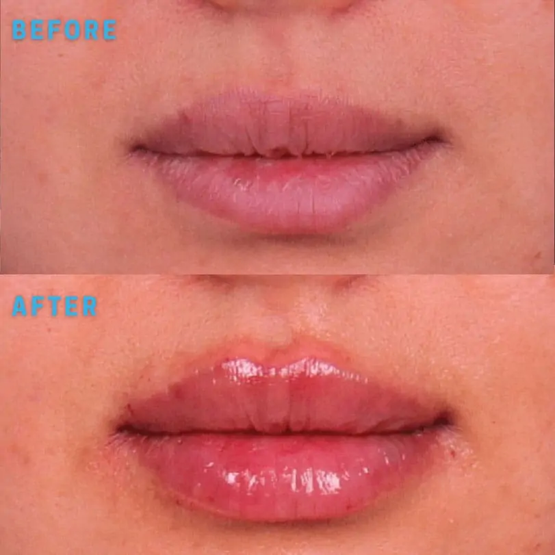 Lip Filler