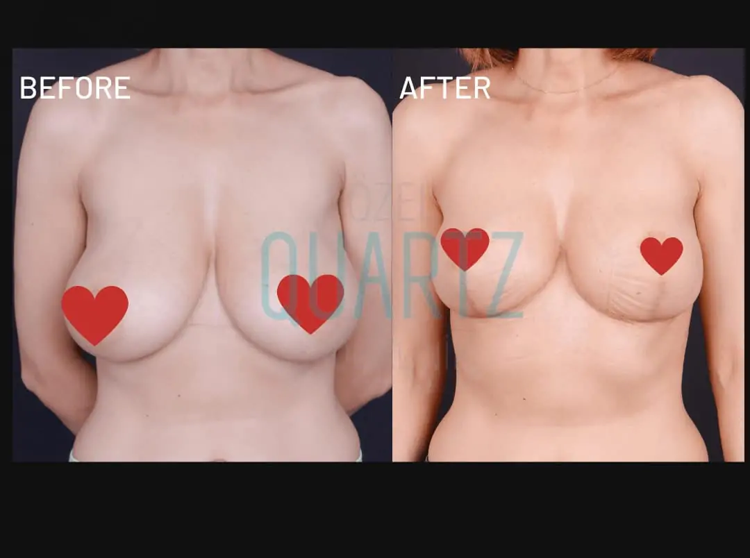 Breast Reduction Surgery