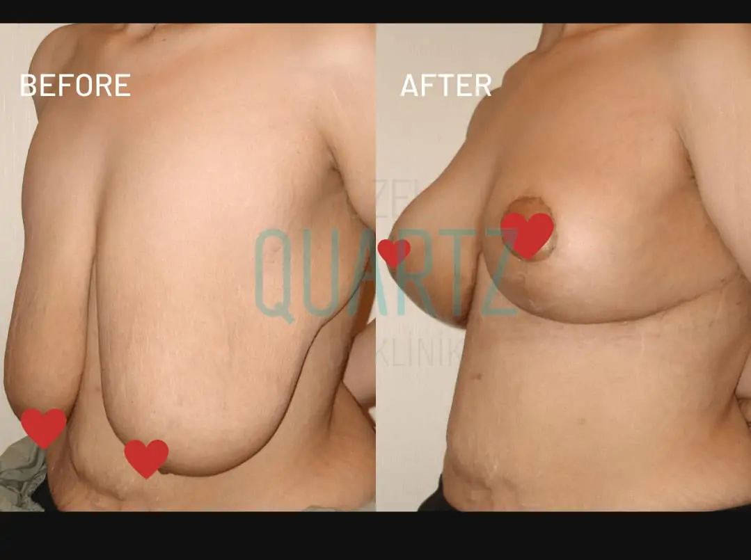 Breast Reduction Surgery