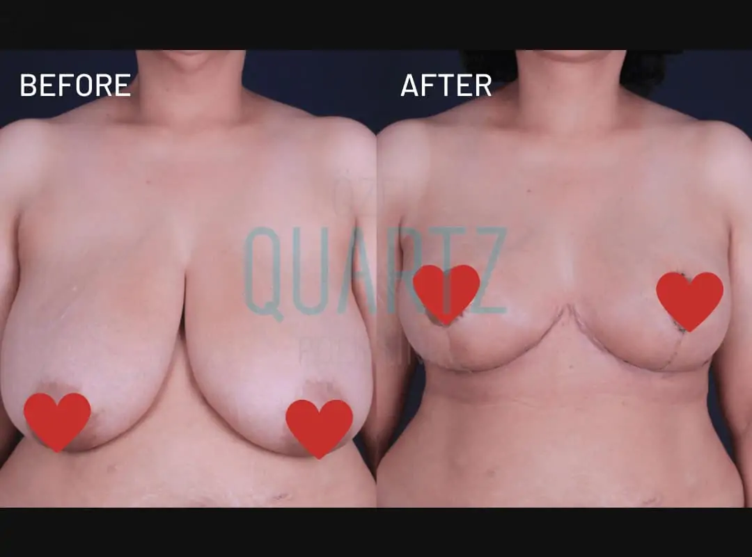 breast reduction