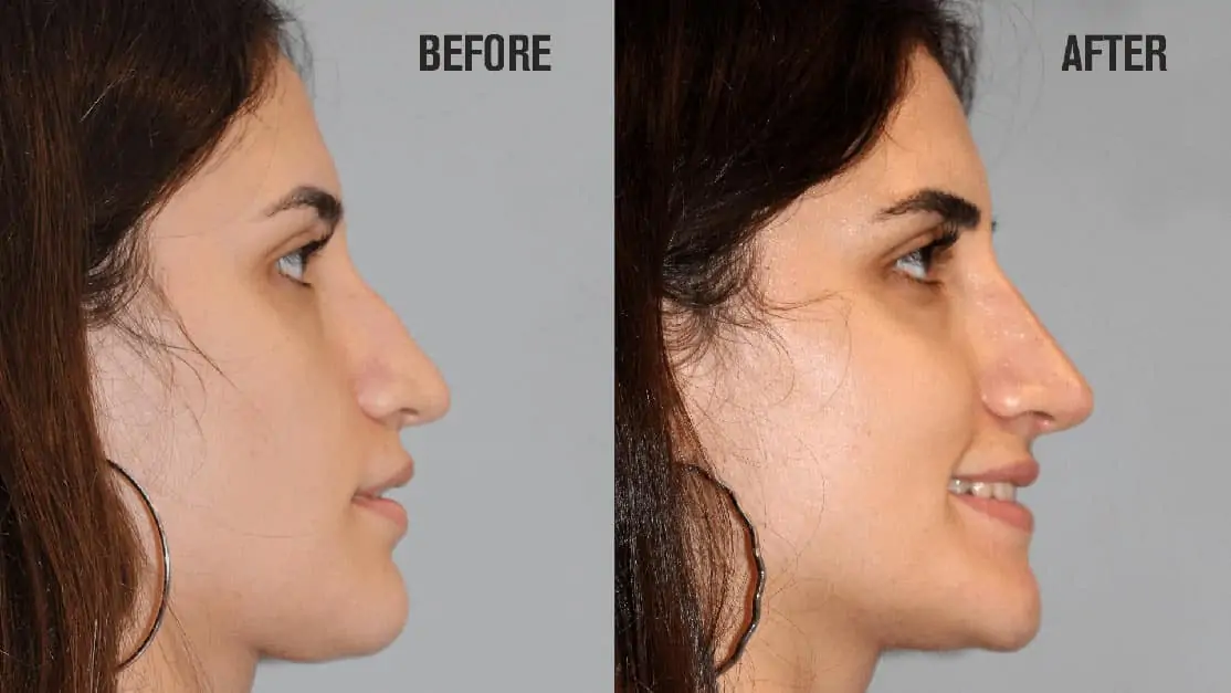 Nose Filler