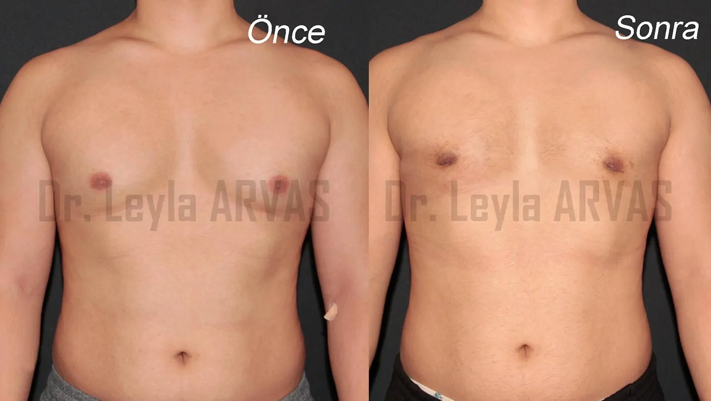 Gynecomastia Surgery