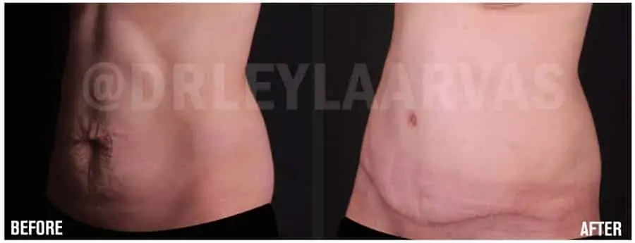 Tummy Tuck