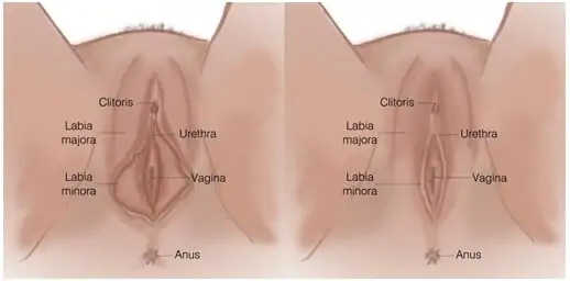 Labiaplasty