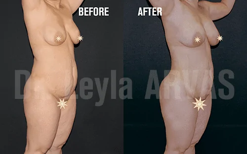 Liposuction