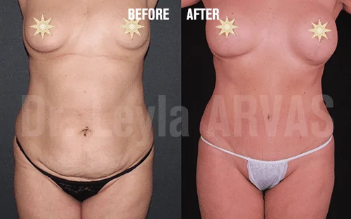 Vaser Liposuction