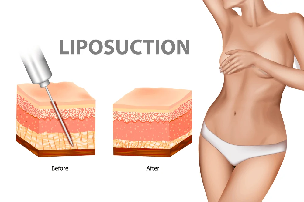 Liposuction