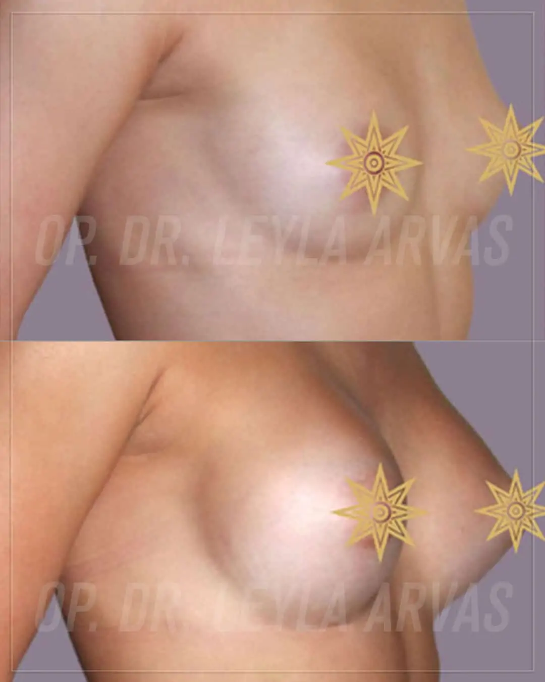 Breast Augmentation