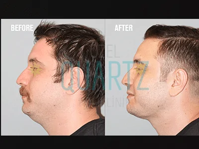 Double Chin Liposuction 