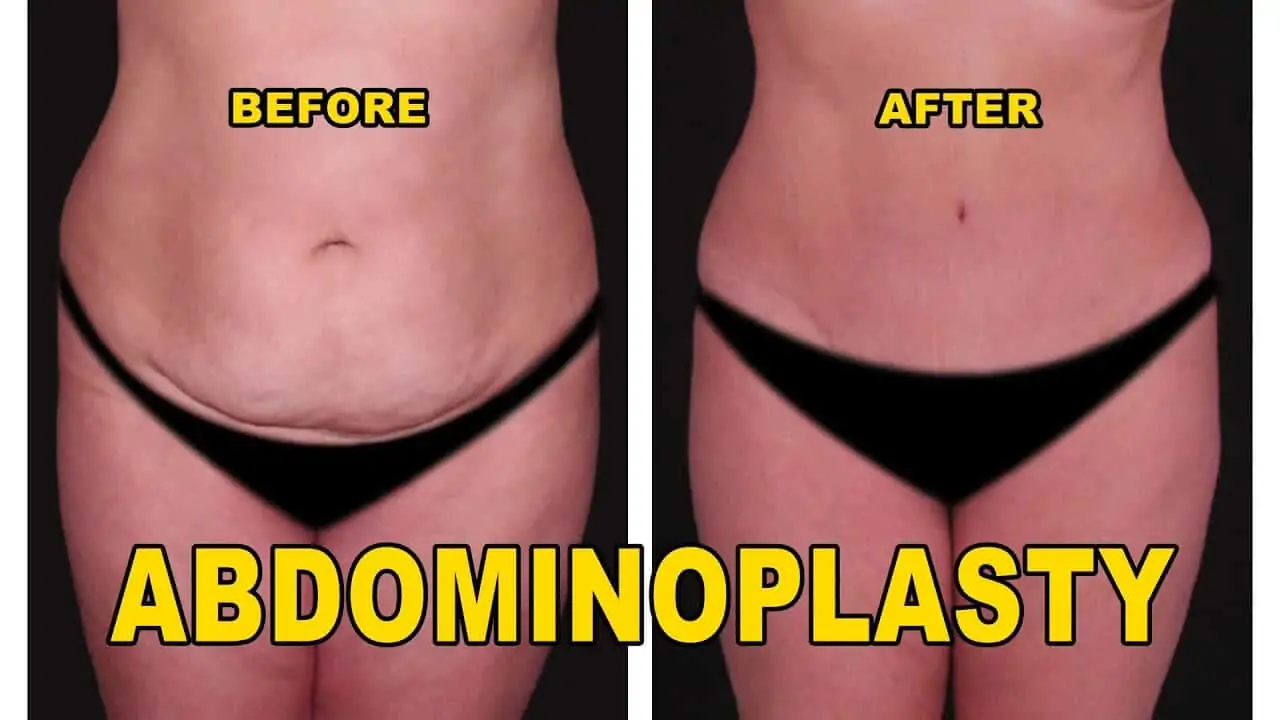 Abdominoplasty