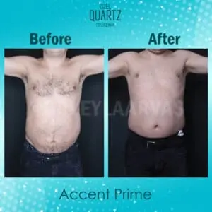 Accent Prime