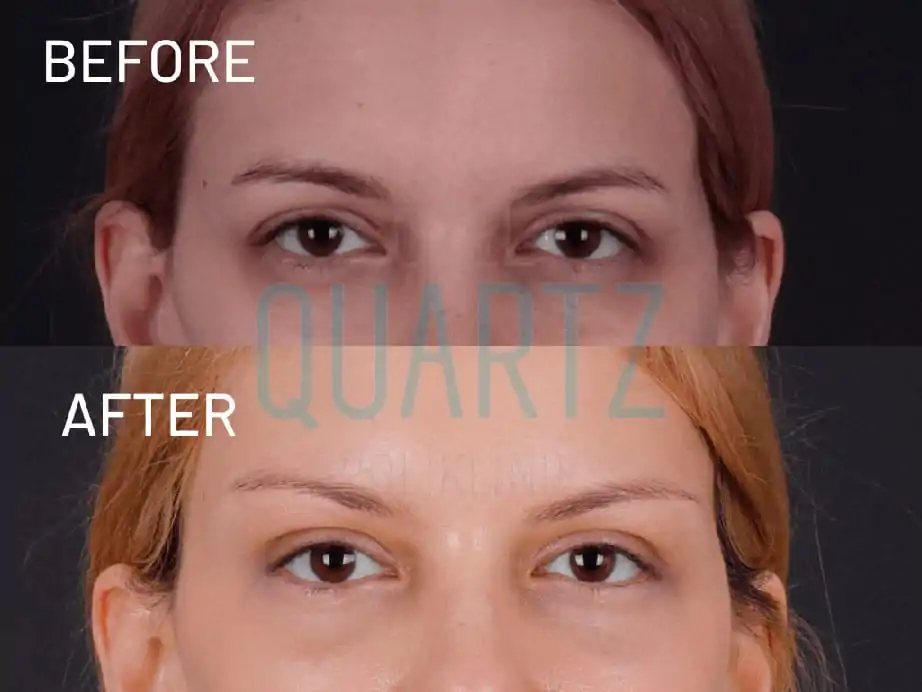 Eyelid Surgery (Blepharoplasty)