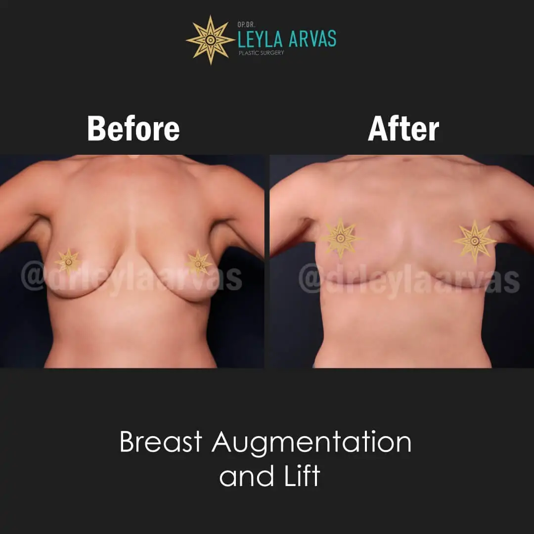 Breast Augmentation