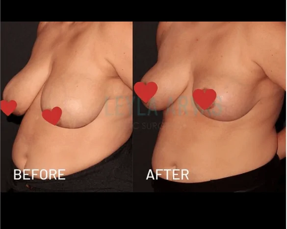 Breast Lift 