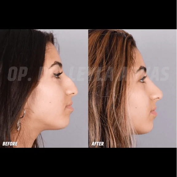 Nose Filler before after