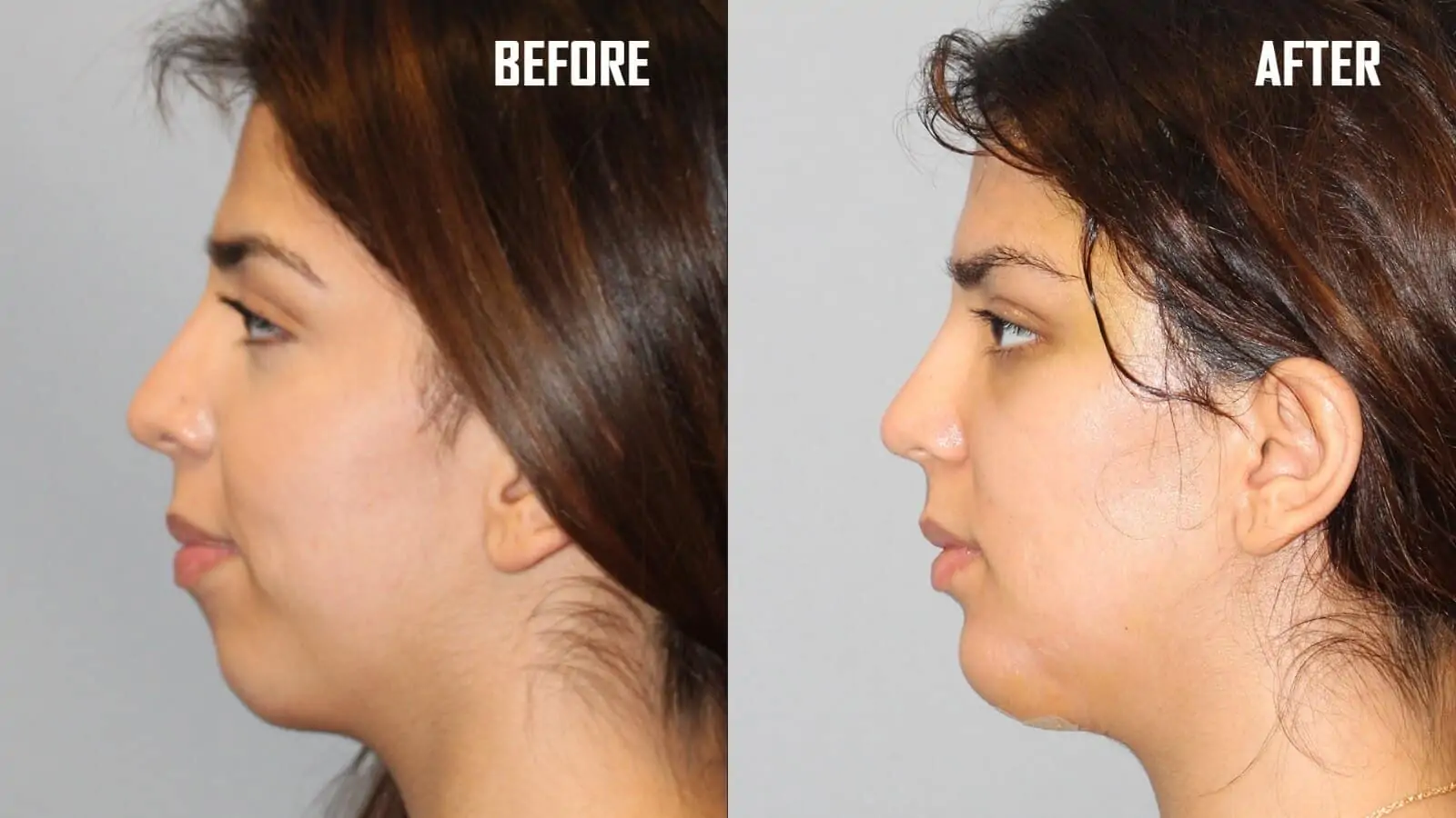 Chin Augmentation