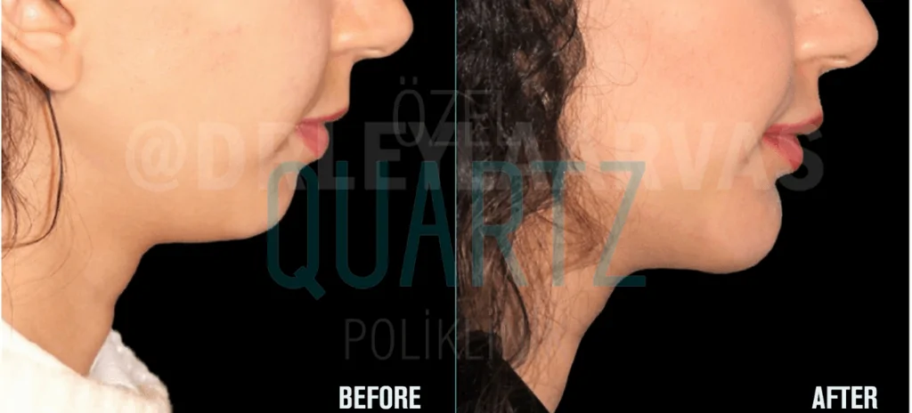 Chin Augmentation