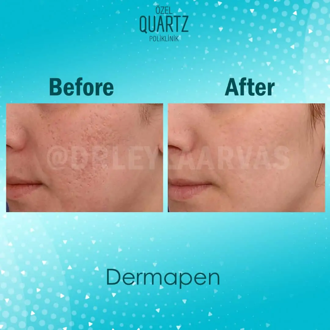 dermapen