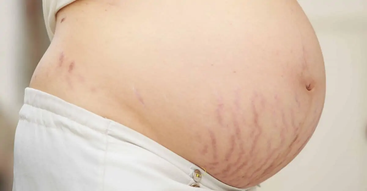 Stretch Marks Treatment