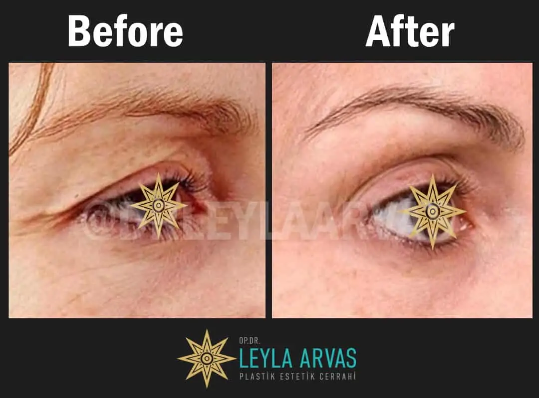 Eyelid Surgery (Blepharoplasty)