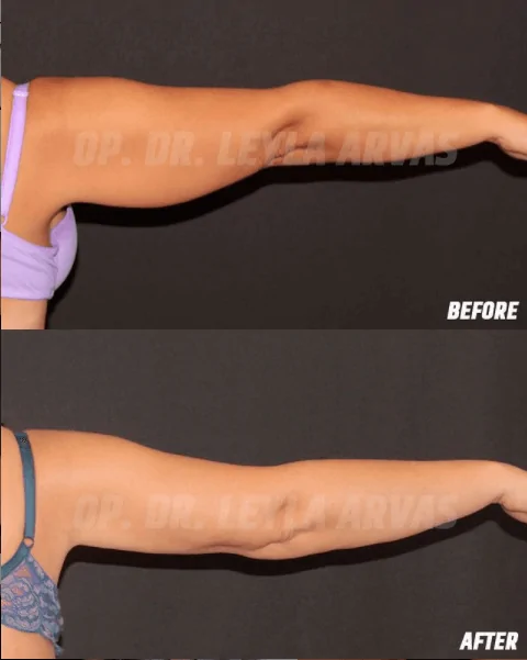 Arm Lift (Brachioplasty)