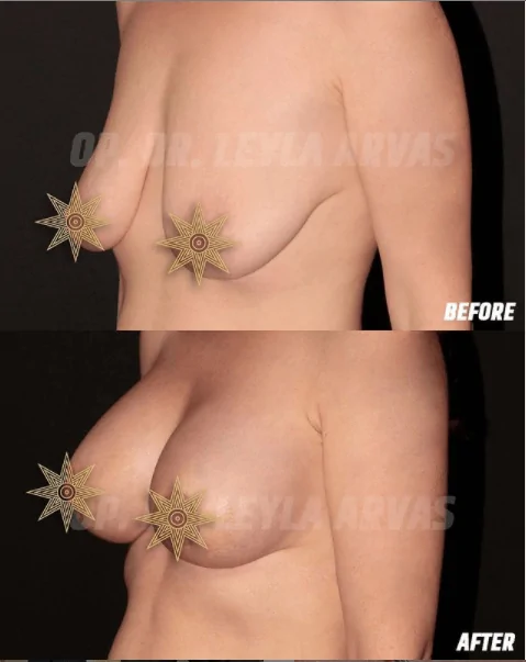 Breast Lift