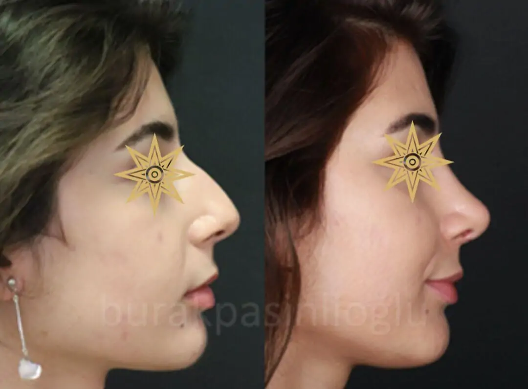 Nose Surgery (Rhinoplasty)