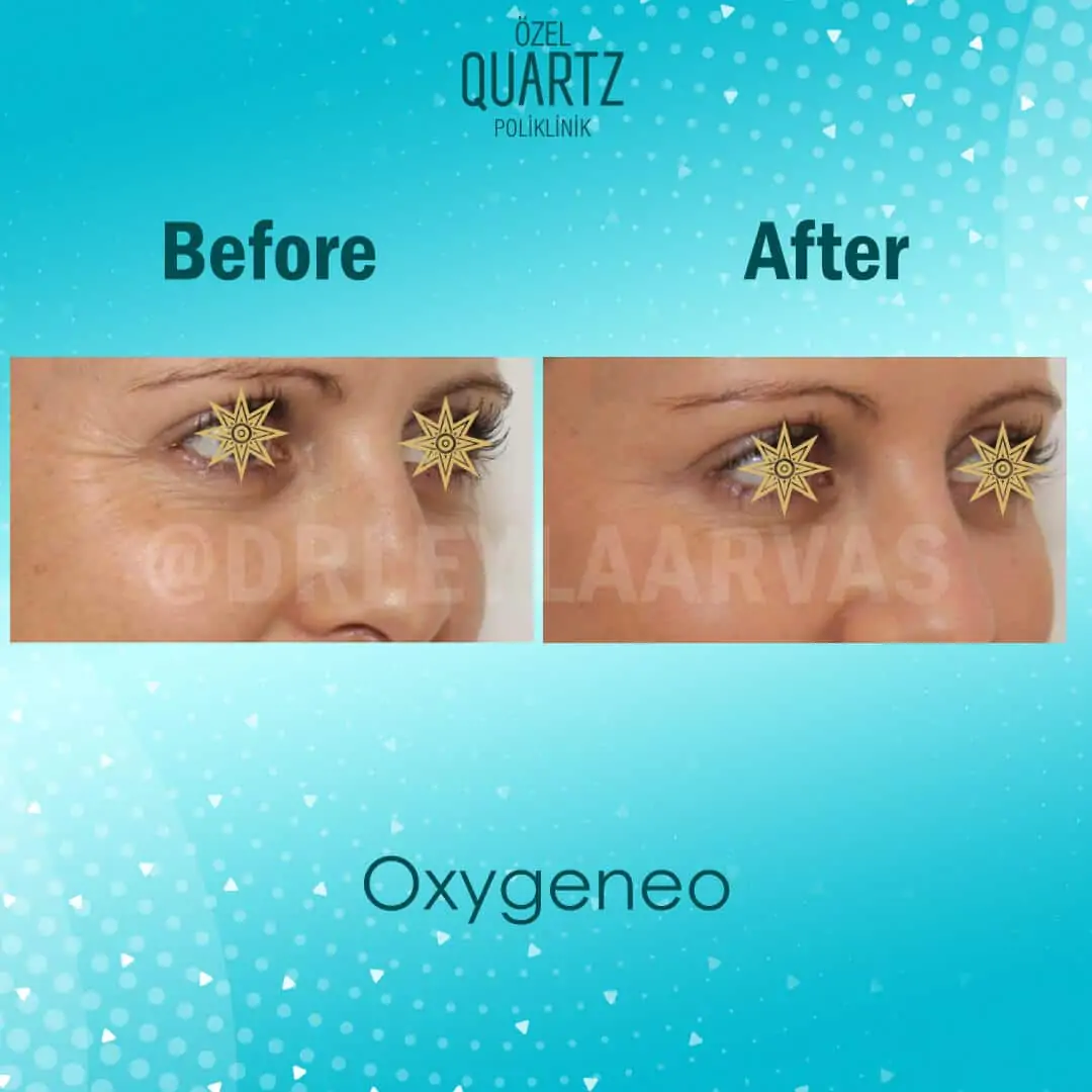 OxyGeneo Facial