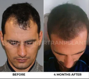 Haartransplantation