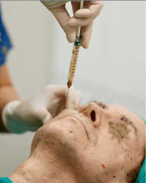 Facial Fat Transfer