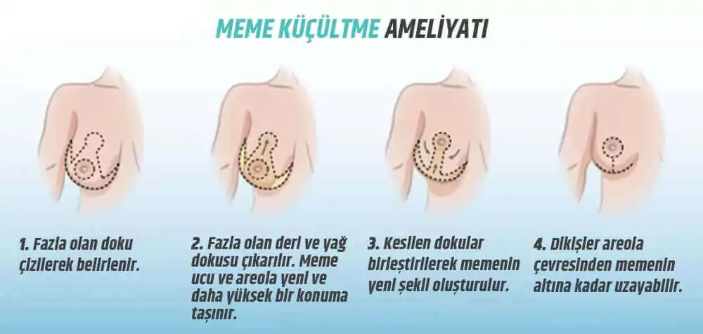 Göğüs Küçültme Ameliyatı Nedir