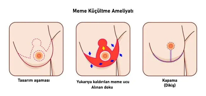 Göğüs Küçültme Ameliyatı Sonrası İz Kalır mı