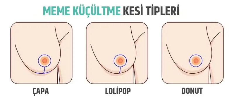 Göğüs Küçültme Nasıl Yapılır