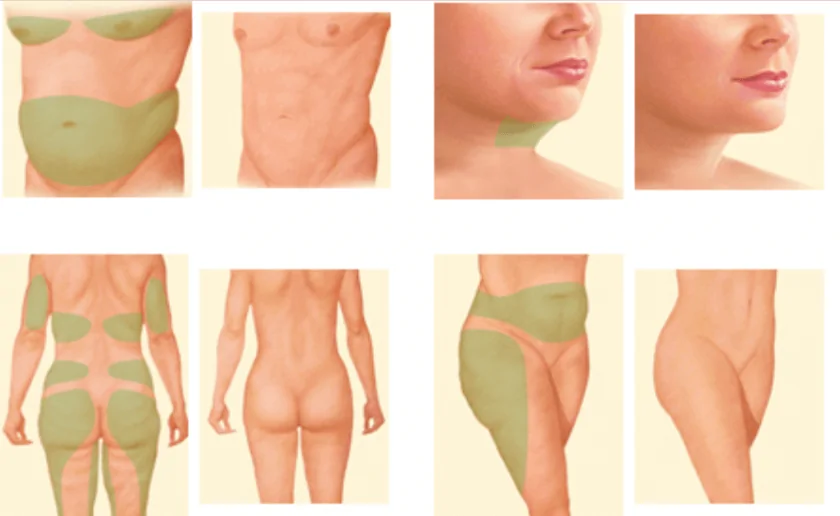 Liposuction Nereye Yapılabilir