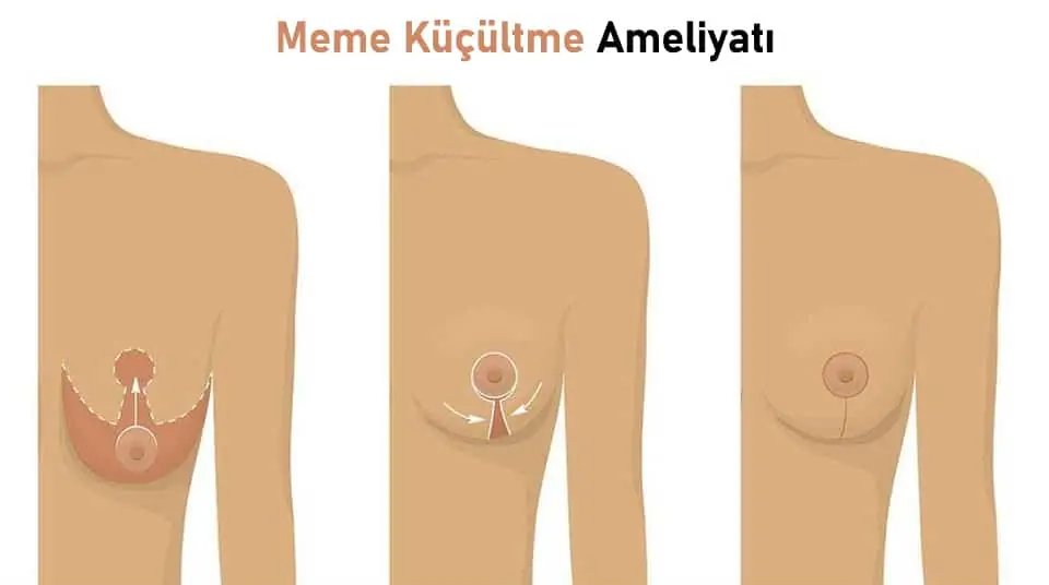 Meme Küçültme Ameliyatı Sonrası Ağrı Olur mu