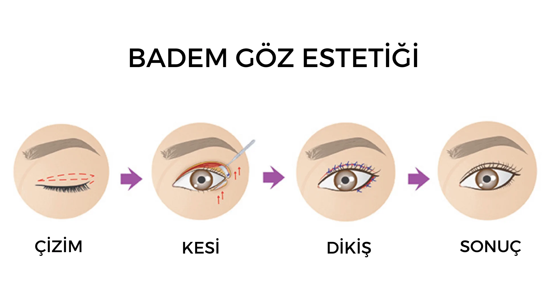 Badem Göz Estetiği Nedir