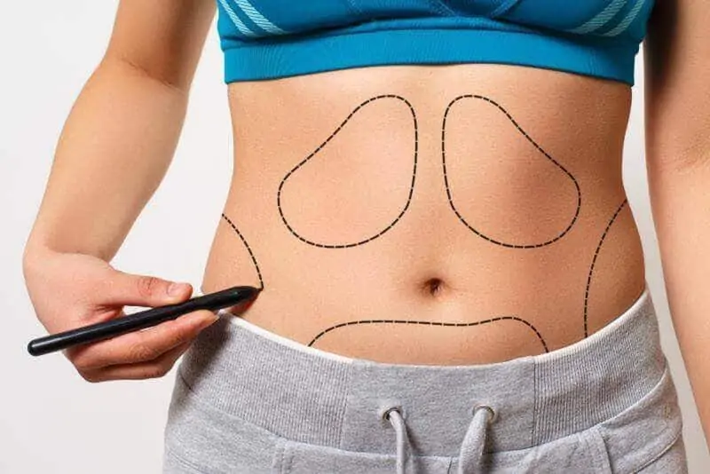 liposuction