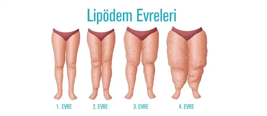 lipodem evre